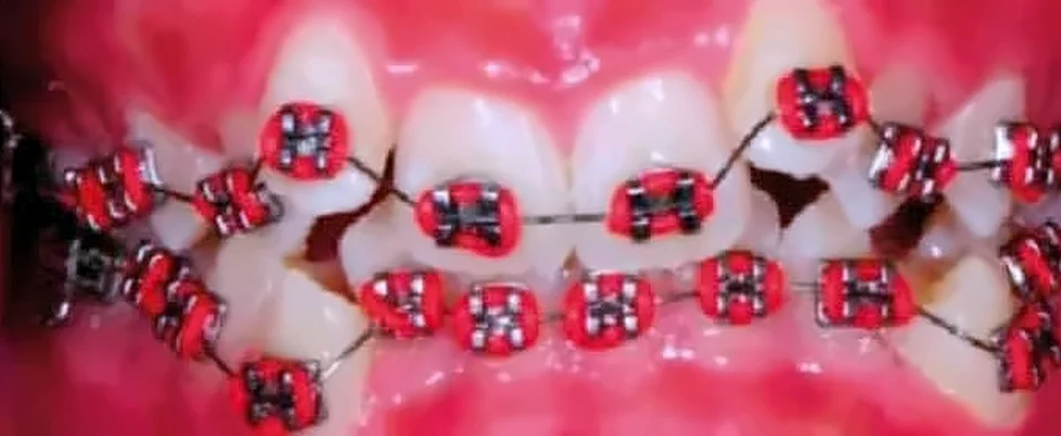 Antes: dientes apiñados con brackets