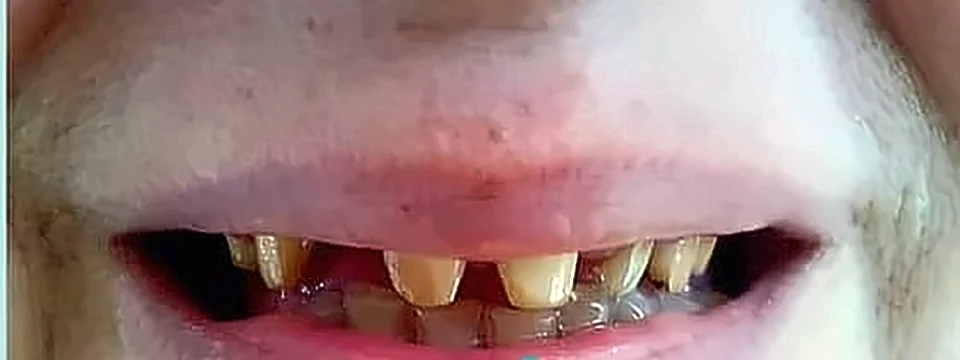 Antes: dientes anteriores desgastados y oscuros