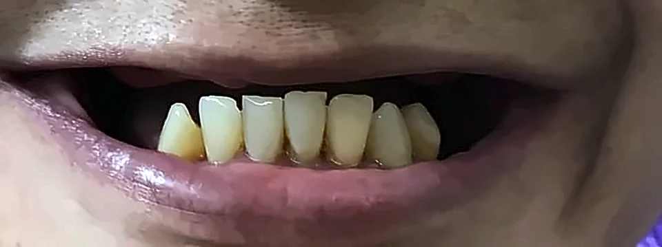 Antes: faltan los dientes superiores