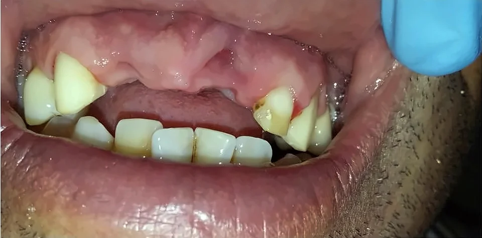 Antes: faltan los dientes anteriores superiores