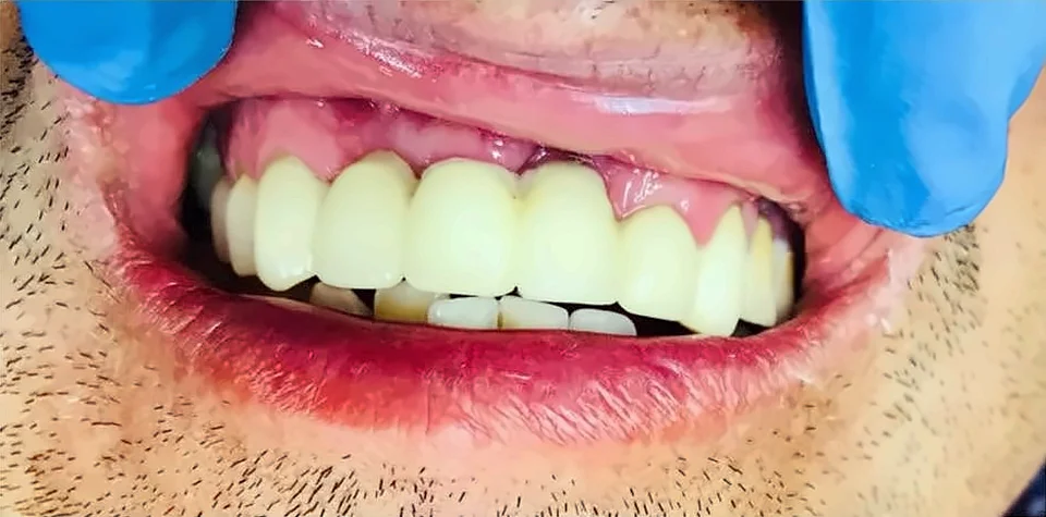 Después: dientes anteriores superiores repuestos