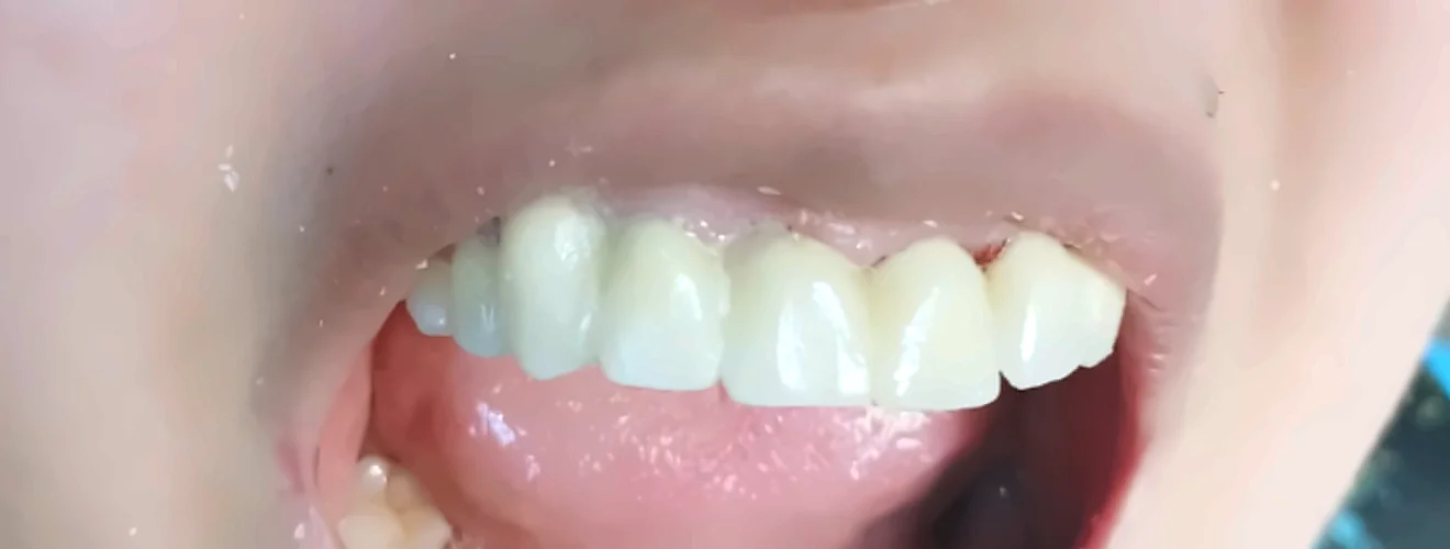 Después: dientes superiores de porcelana